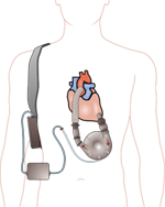 Ventricular Assis Device